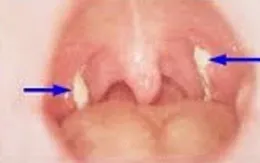 Bệnh bạch hầu có nguy hiểm không?