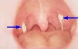 Những biến chứng chết người của bệnh bạch hầu