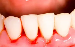 Bệnh nha chu làm tăng nguy cơ ung thư vú