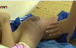 Cháu bé 13 tuổi bị cha đánh tại Thái Nguyên có thể xuất viện sau 1 tuần