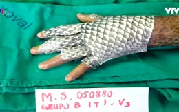 Trị bỏng bằng... da cá