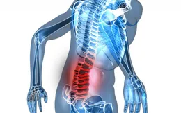 Điều trị hiệu quả chứng đau lưng bằng y học cổ truyền
