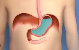 Trào ngược dạ dày thực quản: Nhận biết qua dấu hiệu nào?