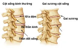 Điều trị bệnh gai cột sống bằng vật lý trị liệu