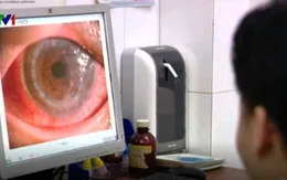 Ghép thành công giác mạc do bác sĩ hiến tặng