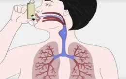 Biện pháp kiểm soát hen phế quản hiệu quả