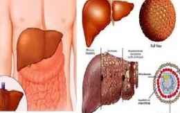 Chữa viêm gan B, C theo hướng điều trị suốt đời