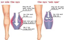 Suy tĩnh mạch mạn tính - bệnh không đơn giản