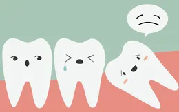 Những phiền toái từ chiếc răng "khôn" nhưng mọc "dại"