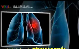 Phát hiện và điều trị sớm bệnh lao