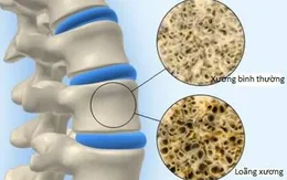 Loãng xương, thoái hóa khớp không còn là 'bệnh của người già'