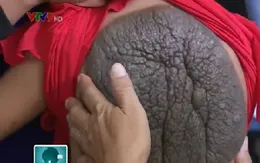 Việt Nam lần đầu tiếp nhận ca phẫu thuật cho bé gái có “lưng rùa”