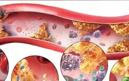 Hạt nano giúp điều trị các tổn thương mạch máu