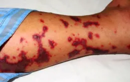 Sự nguy hiểm của bệnh viêm màng não mủ do mô cầu