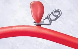 Phương pháp mới trong điều trị dự phòng phình mạch não