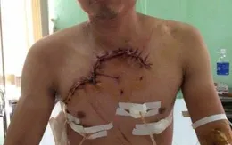 Cứu sống bệnh nhân TNGT bị lộ tim, phổi ra ngoài thành ngực