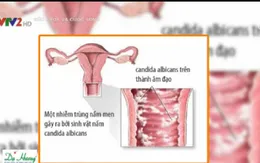 Phòng bệnh phụ khoa trong mùa nồm ẩm