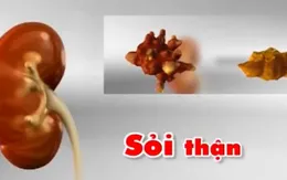 Những nguyên nhân gây bệnh sỏi thận?