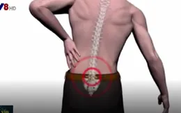 Đề phòng bệnh thoát vị đĩa đệm