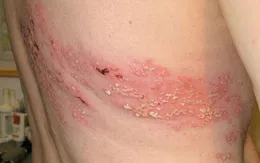 Phương pháp phòng ngừa, điều trị đúng cách bệnh Zona