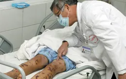 Hà Nội ghi nhận ca viêm não mô cầu đầu tiên năm 2016
