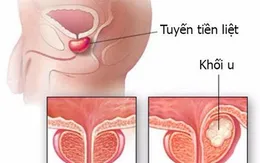 10 căn bệnh ung thư có nguy cơ cao với nam giới