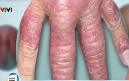 Các phương pháp điều trị bệnh vảy nến