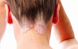 Bệnh vẩy nến và phương pháp điều trị