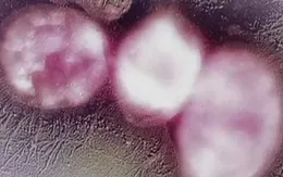 Kiểm soát lây nhiễm vi khuẩn kháng thuốc trong bệnh viện