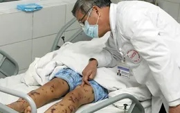 Viêm não mô cầu lây qua đường hô hấp có nguy cơ tử vong cao