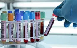 Ứng dụng kỹ thuật phân tử trong xét nghiệm máu sàng lọc virus