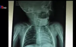 Cứu sống bé trai 8 tháng tuổi nuốt tụ điện