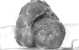 Phẫu thuật thành công cắt bỏ khối u thận gần 1kg tại TP.HCM
