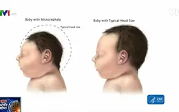 Florida (Mỹ) xác nhận sản phụ đầu tiên nhiễm Zika sinh con đầu nhỏ