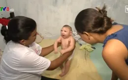 Liệu pháp xoa bóp điều trị trẻ em bị dị tật đầu nhỏ do Zika
