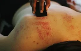 Bị sốt xuất huyết, có nên xông hơi, cạo gió?