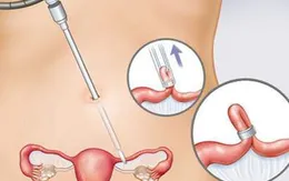 Khi nào nên triệt sản đối với nữ?
