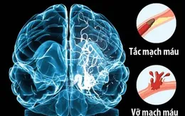 Tìm hiểu về căn bệnh đột quỵ gây nguy hiểm tính mạng