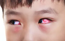 Bệnh đau mắt đỏ và cách phòng trị
