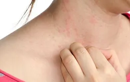 Phát triển thuốc điều trị viêm da dị ứng