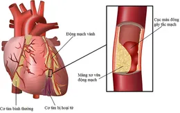 Nguyên nhân gây xơ vữa động mạch vành: Những điều cần biết