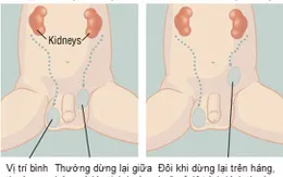 Phát hiện sớm tinh hoàn ẩn ở trẻ