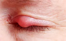 Những điều cần biết về chắp và lẹo mắt