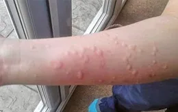 Phòng và điều trị bệnh ngoài da do nhiễm virus
