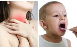 Dấu hiệu nhận biết viêm amidan ở người lớn và trẻ nhỏ