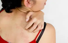 Nếu có một trong những triệu chứng này, bạn cần đi khám lupus ngay