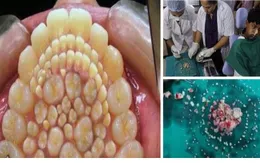 Sốc: Một thiếu niên phải nhổ cùng lúc 232 chiếc răng thừa