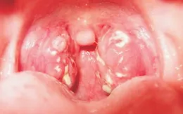 Đắk Lắk: 1 trường hợp tử vong nghi do bệnh bạch hầu