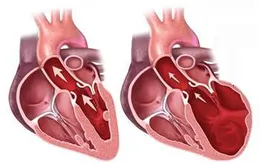 Bệnh lý cơ giãn tim có tỷ lệ tử vong cao