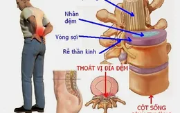 Điều trị thoát vị đĩa đệm hiệu quả bằng Đông y